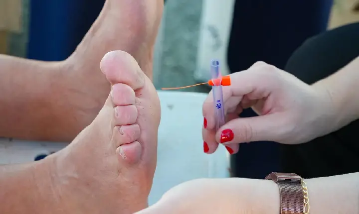 Bertioga realiza ação de rastreamento do pé diabético na próxima semana