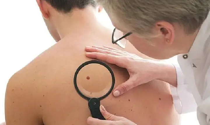 Santos e A.C. Camargo orientam e avaliam população sobre câncer de pele neste domingo