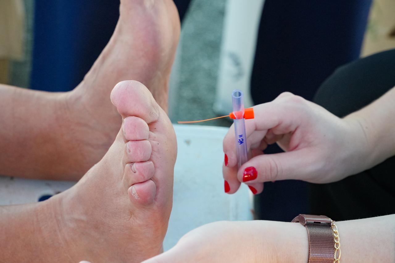 Bertioga realiza ação de rastreamento do pé diabético na próxima semana